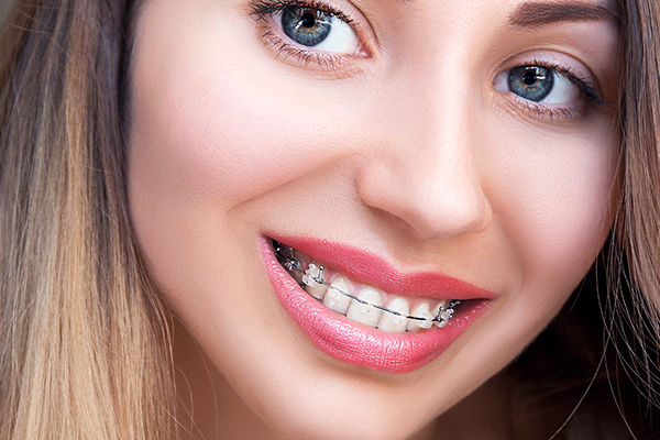 How Clear Braces Can Give You Straighter Teeth