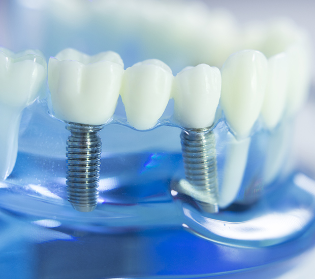 Jacksonville Dental Implants
