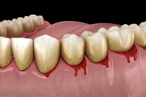 How Gum Disease Causes Damage To Soft Tissue And Bone